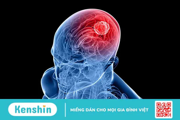 Dấu hiệu có u trong não là gì? Các phương pháp điều trị u não