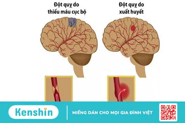 Dấu hiệu đột quỵ trước 30 ngày: Nhận biết và phòng ngừa kịp thời 1