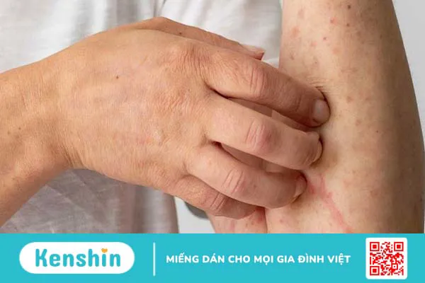 Dấu hiệu giang mai thần kinh và giang mai thị giác