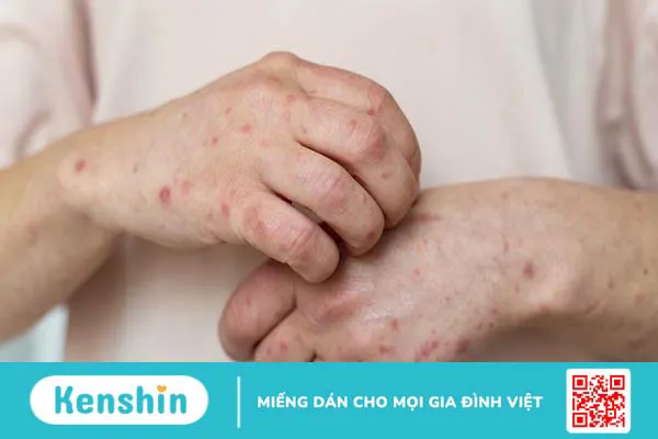 Dấu hiệu giang mai thần kinh và giang mai thị giác