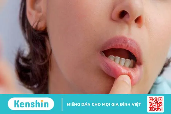 Dấu hiệu nhận biết nổi đẹn ở nướu răng