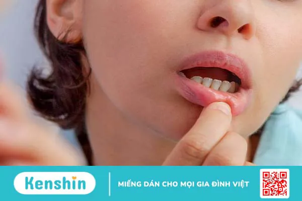 Dấu hiệu nhận biết nổi đẹn ở nướu răng