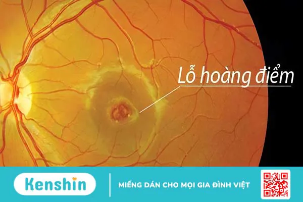 Dấu hiệu nhận biết và phương pháp điều trị bệnh lỗ hoàng điểm