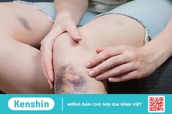 Dấu hiệu rạn xương ống chân là gì? Nguyên nhân do đâu?