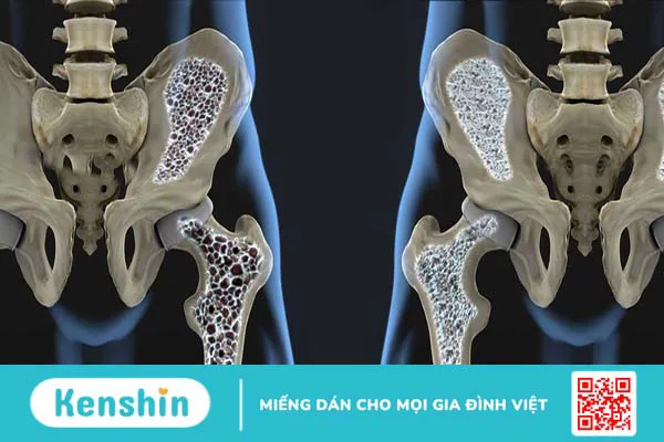 Dấu hiệu thiếu canxi và cách bổ sung canxi an toàn, hiệu quả