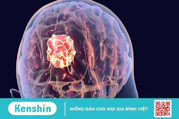 Dấu hiệu ung thư não giai đoạn đầu mà bạn cần cảnh giác