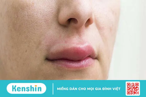 Dấu hiệu và cách chữa dị ứng khi ăn nhộng ong 1