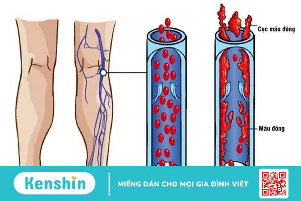 Dấu hiệu và những nơi cục máu đông có thể hình thành 2