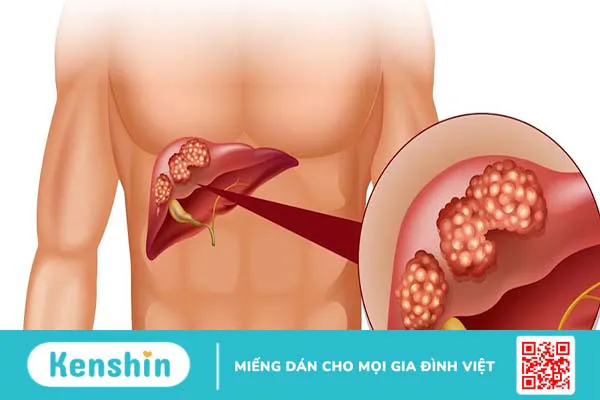 Đau sườn phải dưới nách có nguy hiểm không? 2