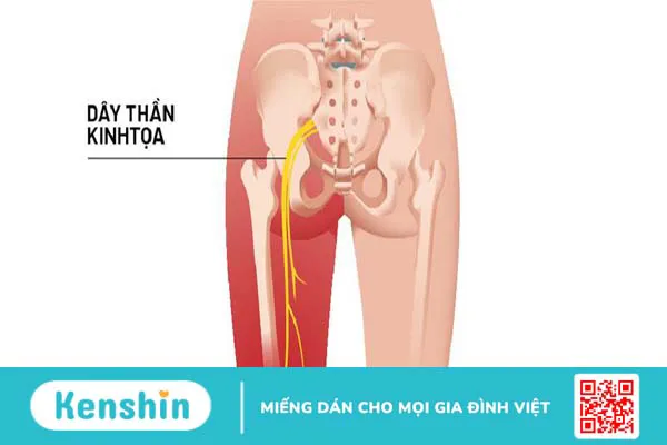 Đau thần kinh tọa có đi xe đạp được không, có ảnh hưởng gì không? 1