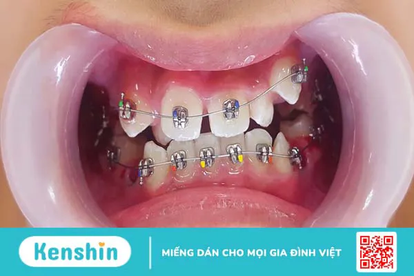 Dây cung niềng răng là gì? Những loại dây cung niềng răng phổ biến nhất