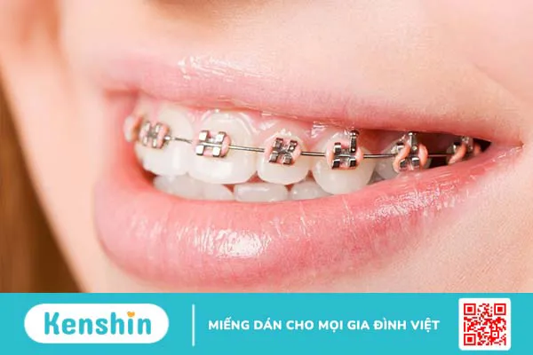 Dây cung niềng răng là gì? Những loại dây cung niềng răng phổ biến nhất