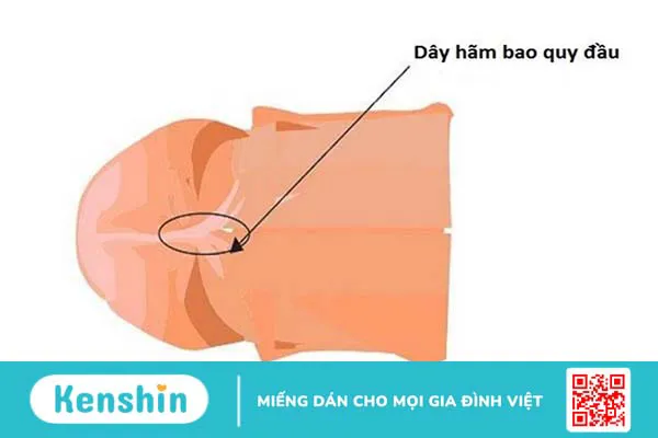 Phải làm gì khi dây hãm bao quy đầu bị xước và cách xử lý an toàn 2