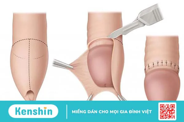 Phải làm gì khi dây hãm bao quy đầu bị xước và cách xử lý an toàn 4