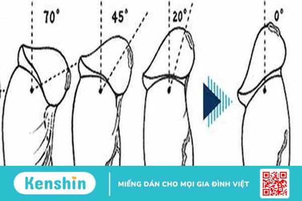 Dây hãm bao quy đầu là gì? Chức năng và các tổn thương thường gặp