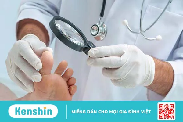 Dày sừng lòng bàn chân và cách điều trị