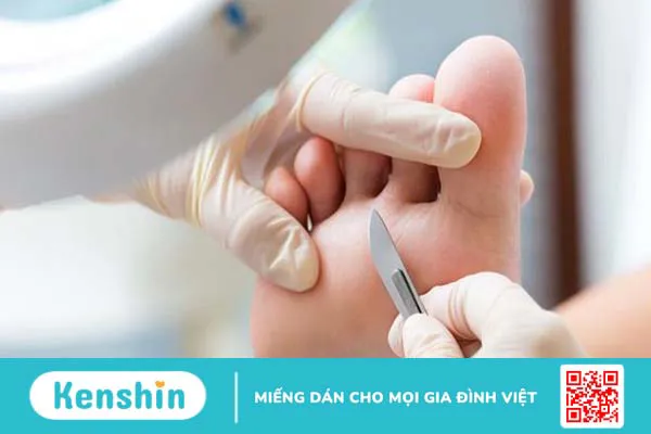 Dày sừng lòng bàn chân và cách điều trị