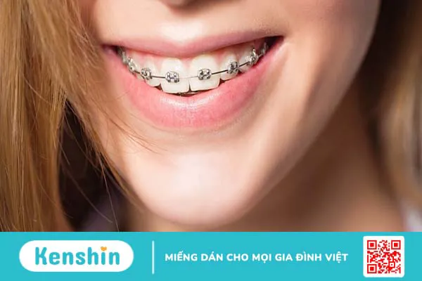 Dây thun niềng răng có tác dụng gì?