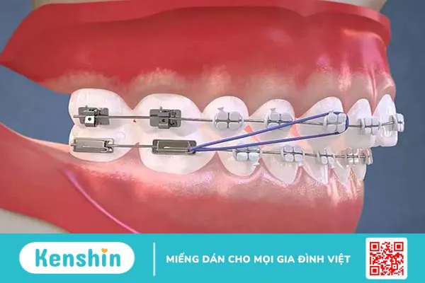 Dây thun niềng răng có tác dụng gì?