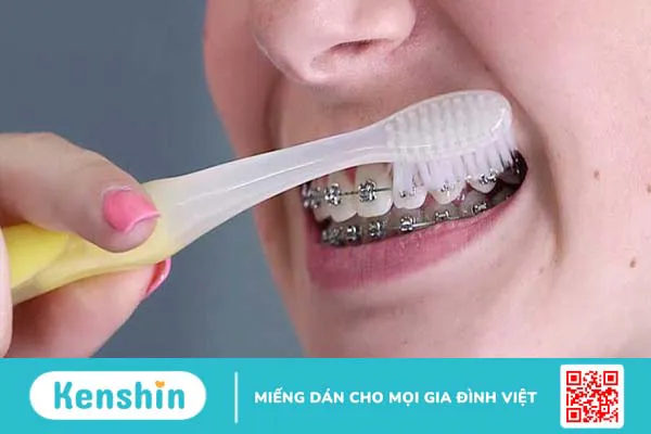 Dây thun niềng răng có tác dụng gì?