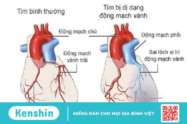 Dị dạng mạch vành là gì? Nguyên nhân, triệu chứng và phương pháp điều trị 1