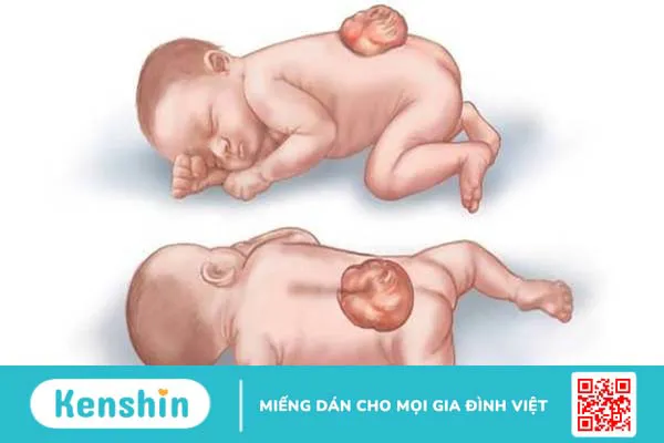 Dị tật cột sống chẻ đôi là gì? Chẩn đoán và điều trị như thế nào?