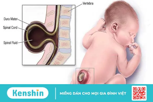 Dị tật cột sống chẻ đôi là gì? Chẩn đoán và điều trị như thế nào?