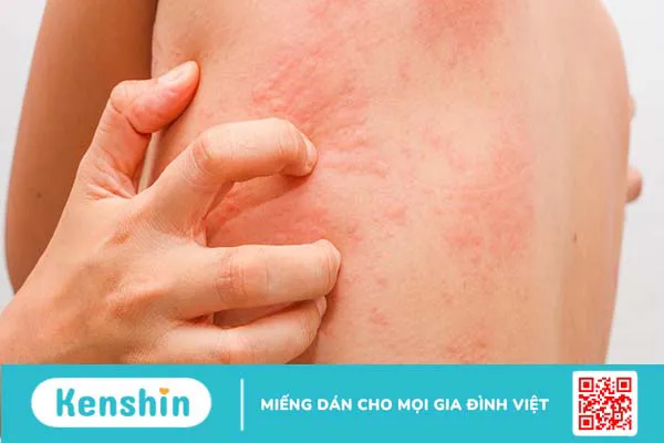 Dị ứng nắng: Nguyên nhân, tác hại và cách phòng ngừa