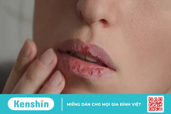 Dị ứng son môi là gì? Nguyên nhân và phương pháp chữa trị