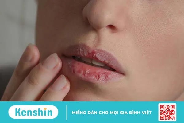 Dị ứng son môi là gì? Nguyên nhân và phương pháp chữa trị