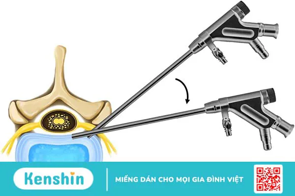 Điều kiện để thực hiện nội soi lấy thoát vị đĩa đệm cột sống