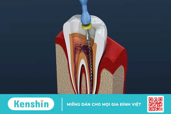 Điều trị nội nha là gì? Tại sao cần phải điều trị nội nha?