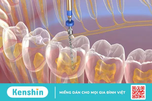 Điều trị nội nha là gì? Tại sao cần phải điều trị nội nha?