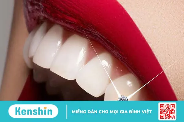 Đính đá răng khểnh có tốt không?