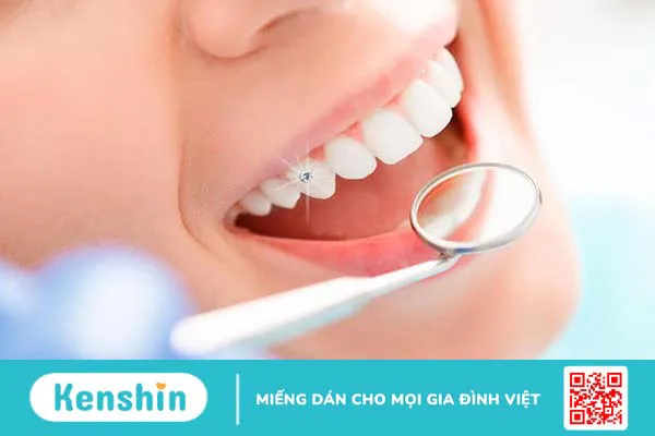 Đính đá răng khểnh có tốt không?