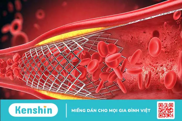 Độ bền của stent mạch vành và những điều cần biết