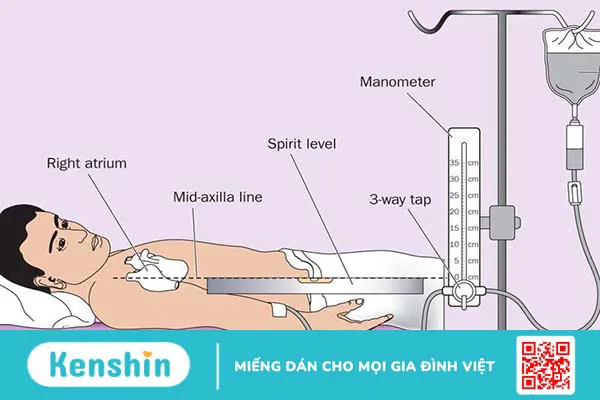 Đo CVP là gì? Quy trình thực hiện đo CVP không phải ai cũng biết 1