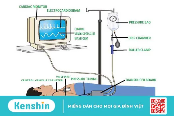 Đo CVP là gì? Quy trình thực hiện đo CVP không phải ai cũng biết 3