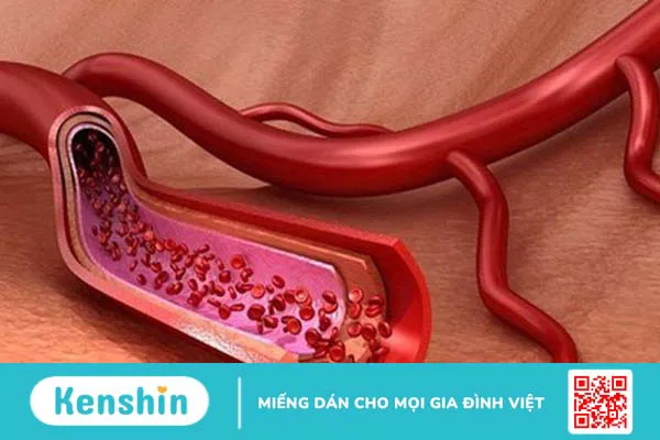 Đo độ cứng động mạch là gì? Giá trị và phương pháp đo độ cứng động mạch