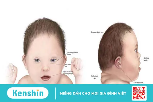 Độ mờ da gáy bình thường có cần làm Double Test nữa hay không?