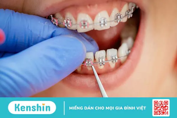 Độ tuổi niềng răng tốt nhất là khi nào? Những điều cần lưu ý khi quyết định niềng răng