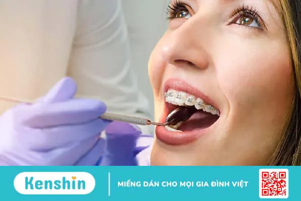 Độ tuổi niềng răng tốt nhất là khi nào? Những điều cần lưu ý khi quyết định niềng răng 1