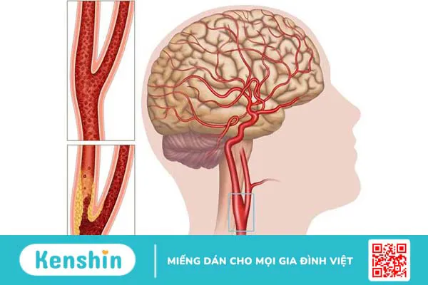 Động mạch cổ nằm ở vị trí nào? Chức năng và vai trò trong lâm sàng 3