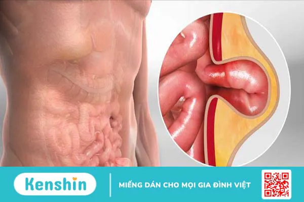 Động mạch thượng vị dưới nằm ở đâu và những vấn đề liên quan