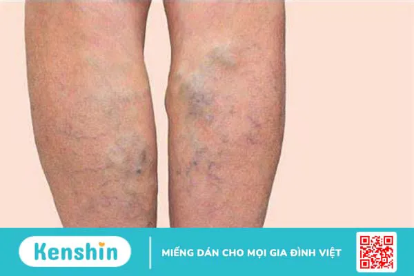 Tìm hiểu về đông máu nội mạch lan tỏa 3