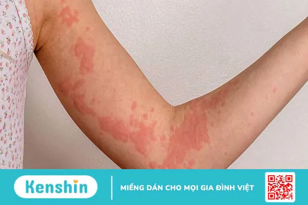 Dung dịch xịt ngoài da Skin Herbal làm dịu vết ngứa và giảm mề đay hiệu quả