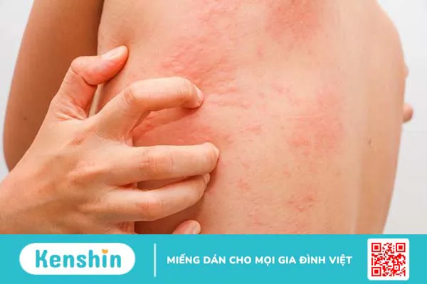 Dung dịch xịt ngoài da Skin Herbal làm dịu vết ngứa và giảm mề đay hiệu quả