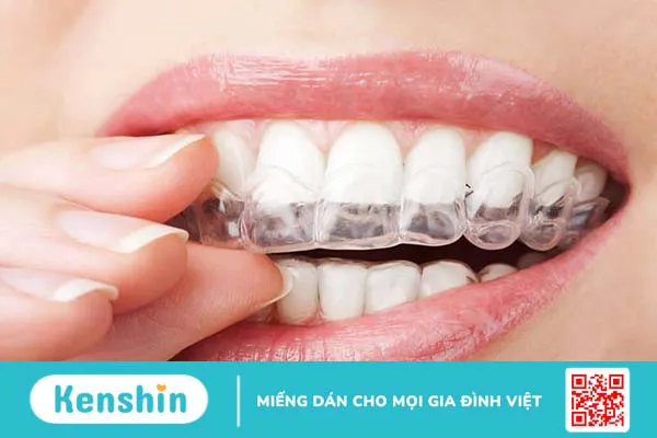 Gắn Attachment khi niềng răng Invisalign có tác dụng gì?