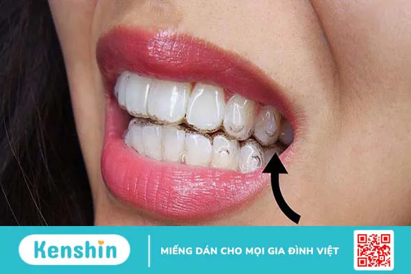 Gắn Attachment khi niềng răng Invisalign có tác dụng gì?