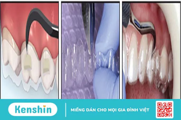 Gắn Attachment khi niềng răng Invisalign có tác dụng gì?